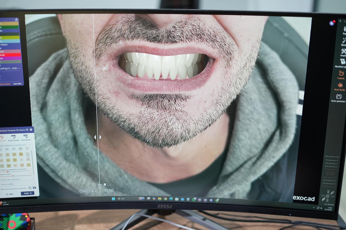 Gülüş Tasarımı (Hollywood Smile)